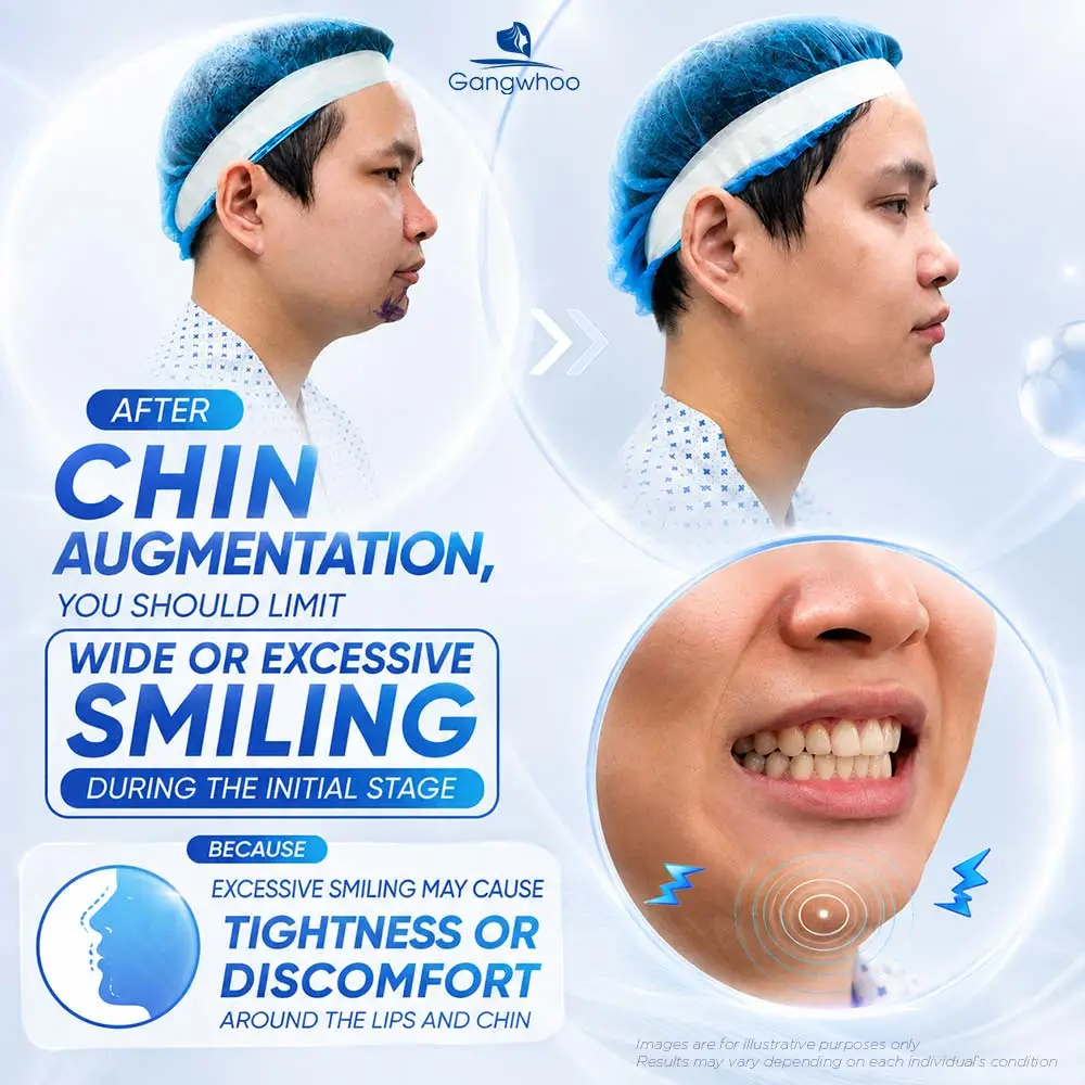 How Long After Chin Augmentation Can You Smile? Recovery Care Guide