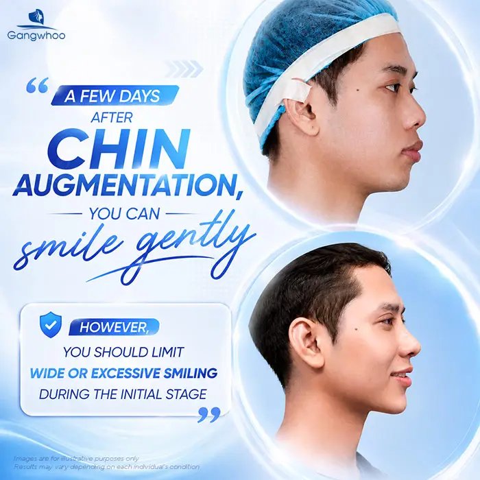 How Long After Chin Augmentation Can You Smile? Recovery Care Guide