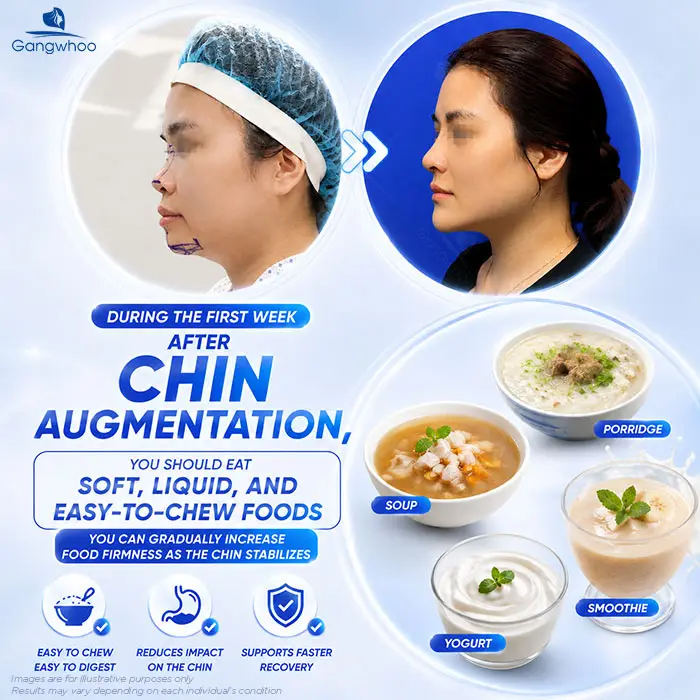 How Long After Chin Augmentation Can You Smile? Recovery Care Guide