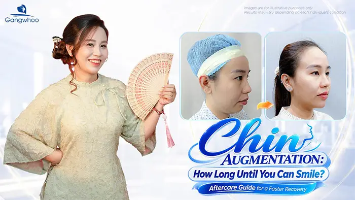 How Long After Chin Augmentation Can You Smile? Recovery Care Guide