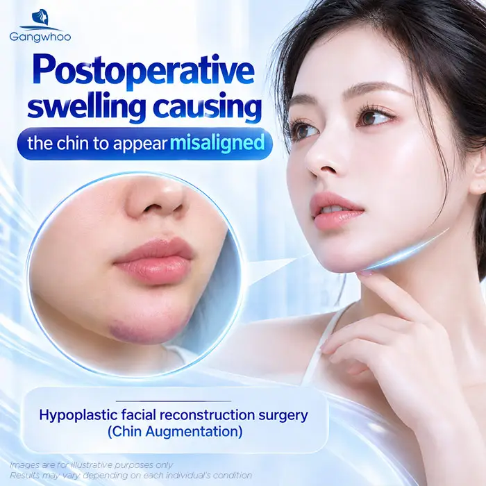 What to Do If Your Chin Implant Shifts Off-Center? Causes and Safe Correction Methods