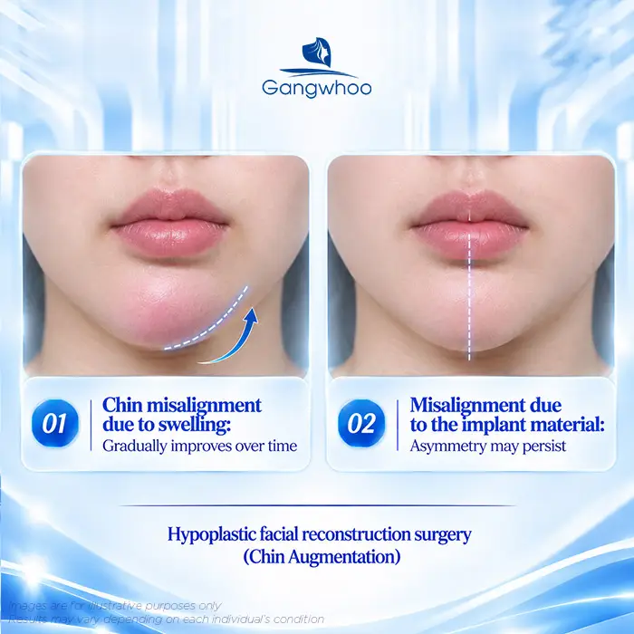 What to Do If Your Chin Implant Shifts Off-Center? Causes and Safe Correction Methods