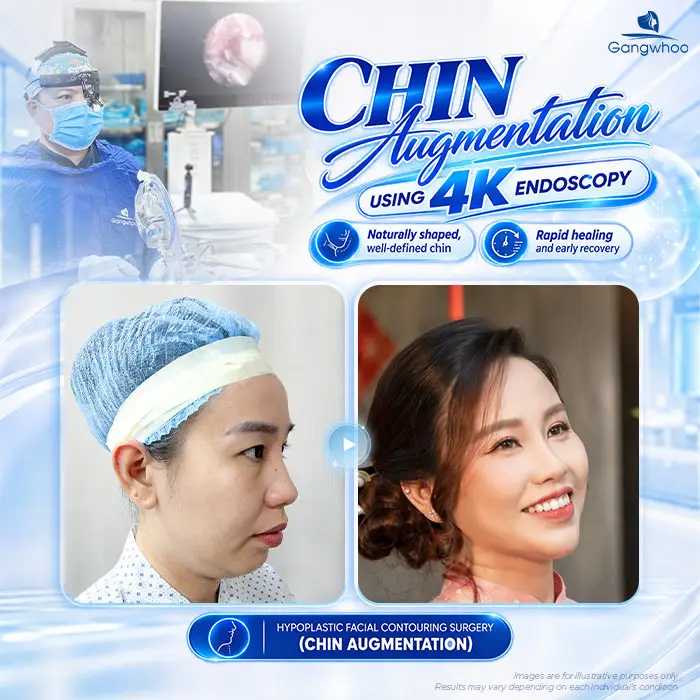 Does Chin Augmentation Hurt? Pain Level and Recovery Time