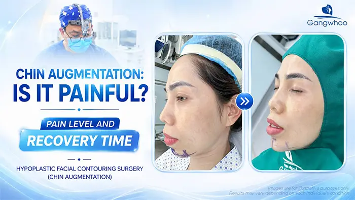 Does Chin Augmentation Hurt? Pain Level and Recovery Time