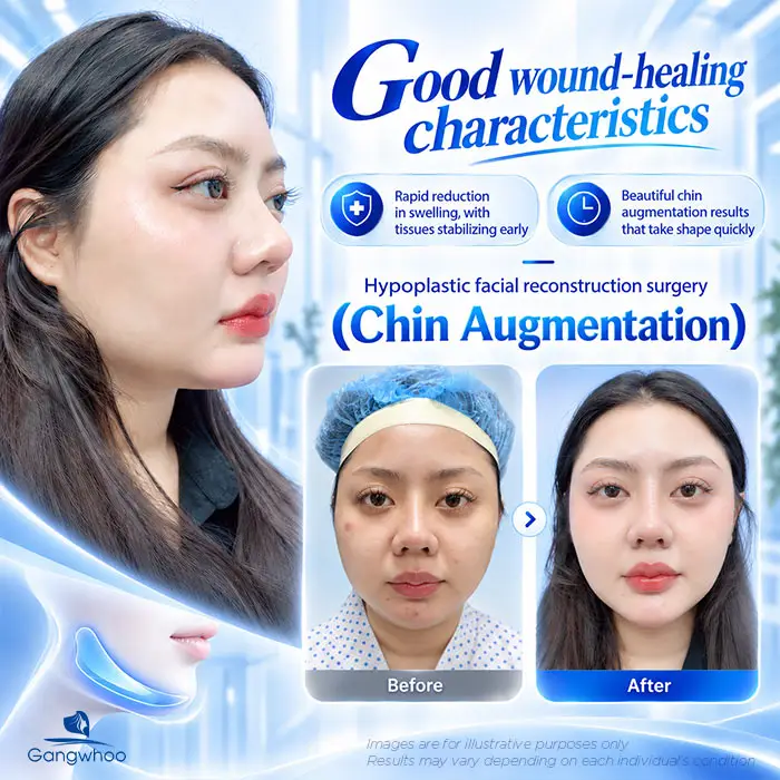 Is Chin Augmentation Permanent? Factors That Affect the Results