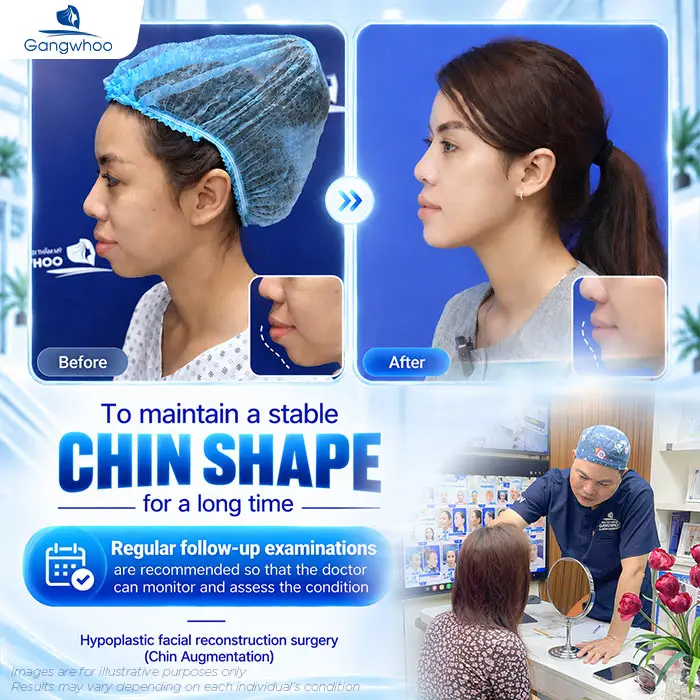 Is Chin Augmentation Permanent? Factors That Affect the Results