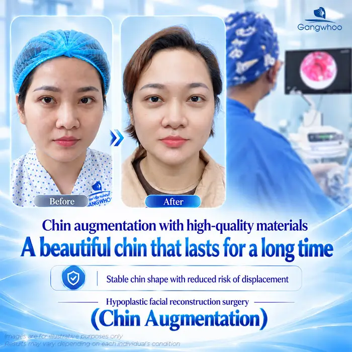 Is Chin Augmentation Permanent? Factors That Affect the Results
