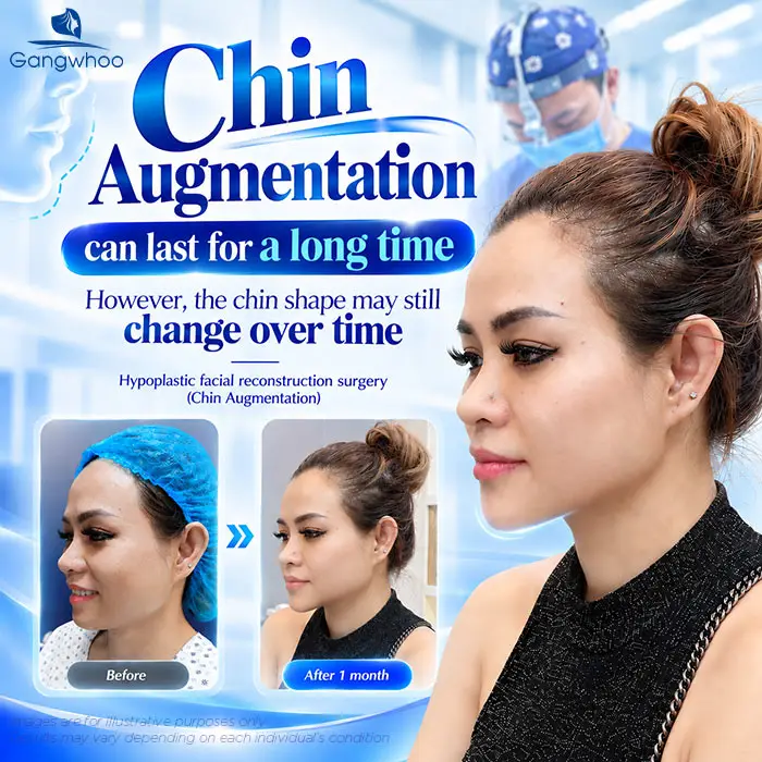 Is Chin Augmentation Permanent? Factors That Affect the Results