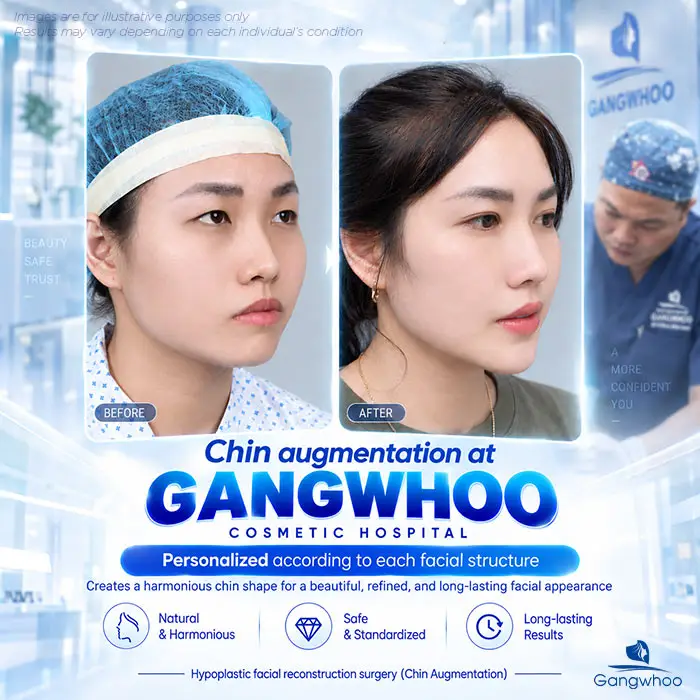 Is Chin Augmentation Permanent? Factors That Affect the Results