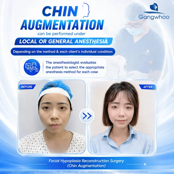 Does chin augmentation require general anesthesia? When Is Local Anesthesia Used, and When Is General Anesthesia Needed?