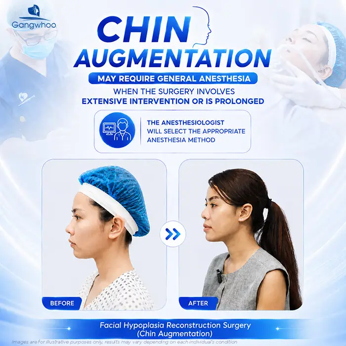 Does chin augmentation require general anesthesia? When Is Local Anesthesia Used, and When Is General Anesthesia Needed?