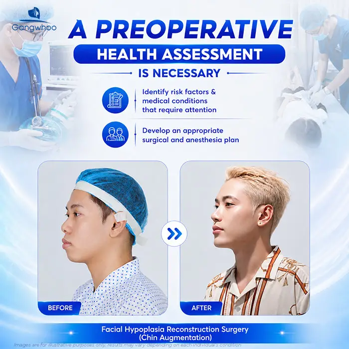 Does chin augmentation require general anesthesia? When Is Local Anesthesia Used, and When Is General Anesthesia Needed?