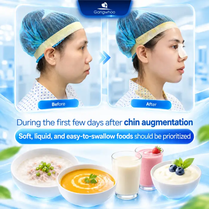 Chin Implant: What Foods to Avoid? How Long Should You Wait Before Eating Normally?