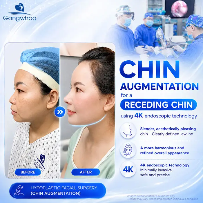 Chin Augmentation for Receding Chin: A Solution to Improve Chin Shape and Facial Contours