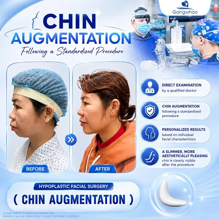 Chin Augmentation for Receding Chin: A Solution to Improve Chin Shape and Facial Contours