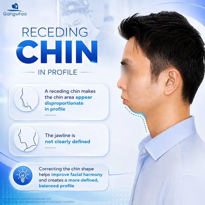 Chin Augmentation for Receding Chin: A Solution to Improve Chin Shape and Facial Contours