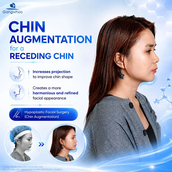 Chin Augmentation for Receding Chin: A Solution to Improve Chin Shape and Facial Contours