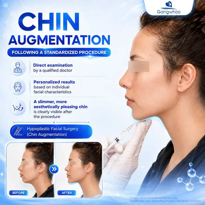 Chin Augmentation for Receding Chin: A Solution to Improve Chin Shape and Facial Contours