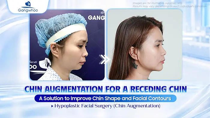 Chin Augmentation for Receding Chin: A Solution to Improve Chin Shape and Facial Contours