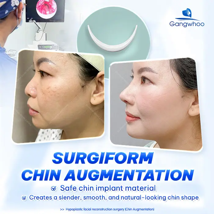 What Is Surgiform Cartilage Chin Augmentation? How Much Does It Cost?