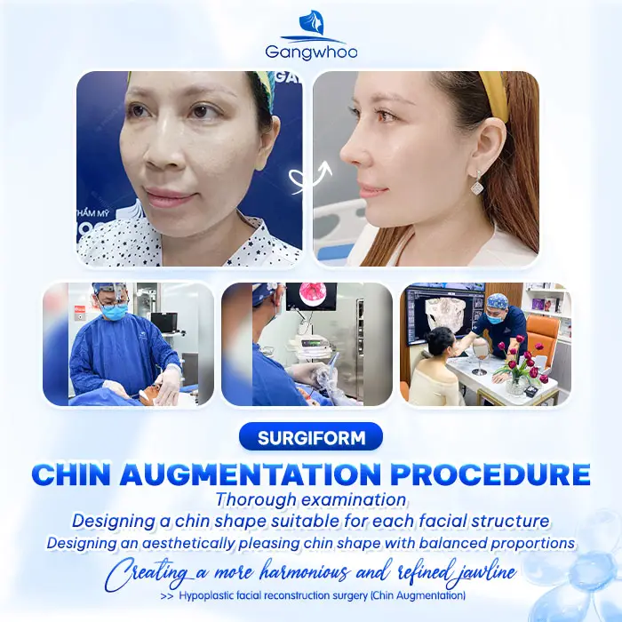 What Is Surgiform Cartilage Chin Augmentation? How Much Does It Cost?
