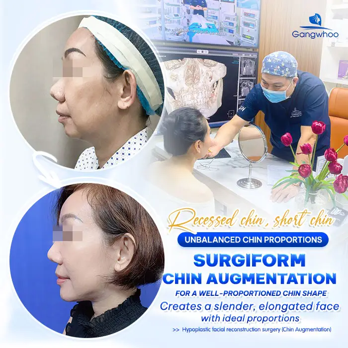What Is Surgiform Cartilage Chin Augmentation? How Much Does It Cost?