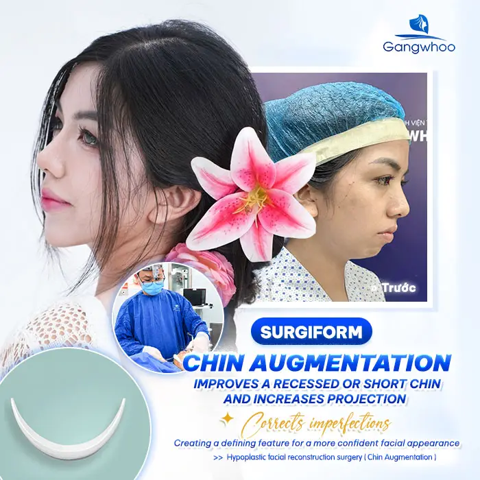 What Is Surgiform Cartilage Chin Augmentation? How Much Does It Cost?