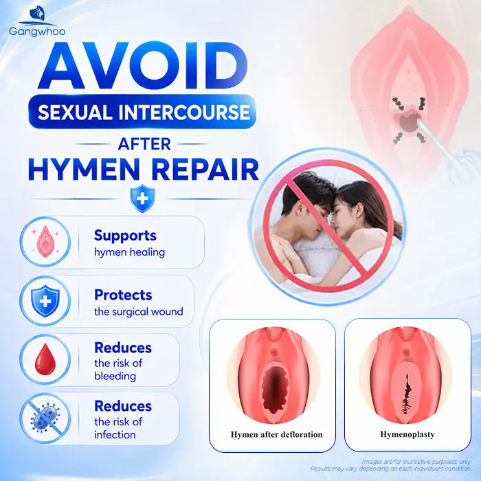 How Long After Hymenoplasty Can You Have Intercourse? Doctor Explains the Safe Timeline