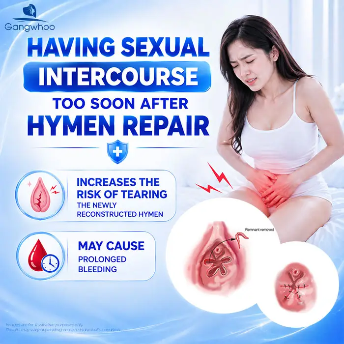 How Long After Hymenoplasty Can You Have Intercourse? Doctor Explains the Safe Timeline