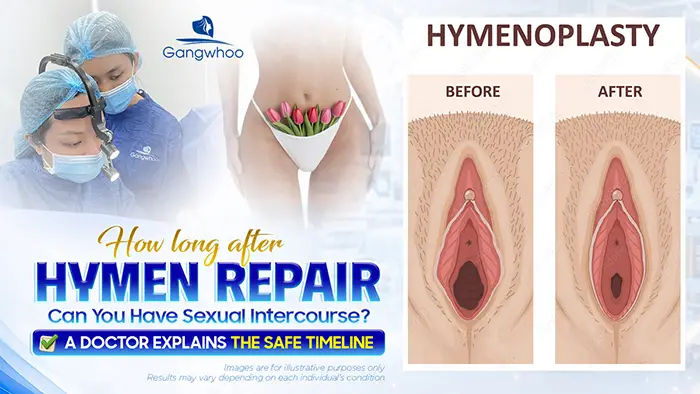 How Long After Hymenoplasty Can You Have Intercourse? Doctor Explains the Safe Timeline