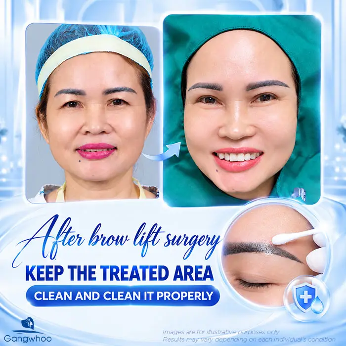 How Long Does Swelling Last After Brow Lift? Proper Aftercare