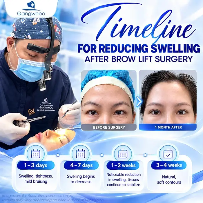 How Long Does Swelling Last After Brow Lift? Proper Aftercare