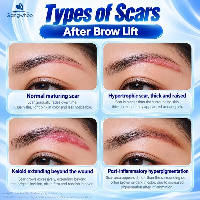 Does Brow Lift Surgery Leave Scars? A Guide to Minimizing Scarring