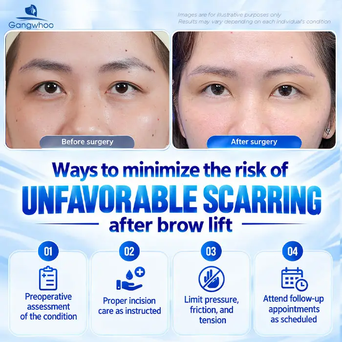 Does Brow Lift Surgery Leave Scars? A Guide to Minimizing Scarring