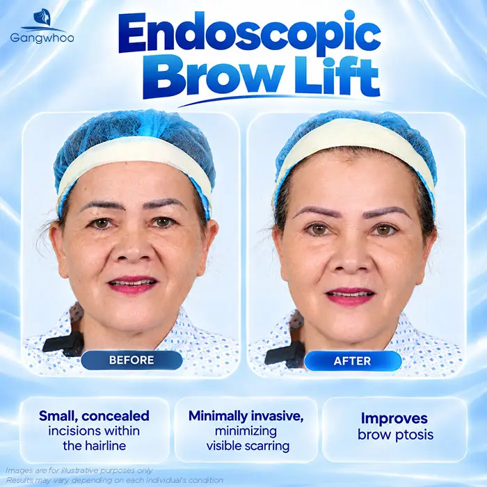 Does Brow Lift Surgery Leave Scars? A Guide to Minimizing Scarring