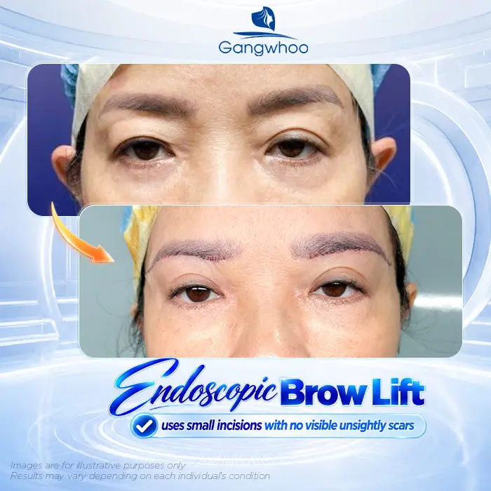 Does Brow Lift Surgery Leave Scars? A Guide to Minimizing Scarring