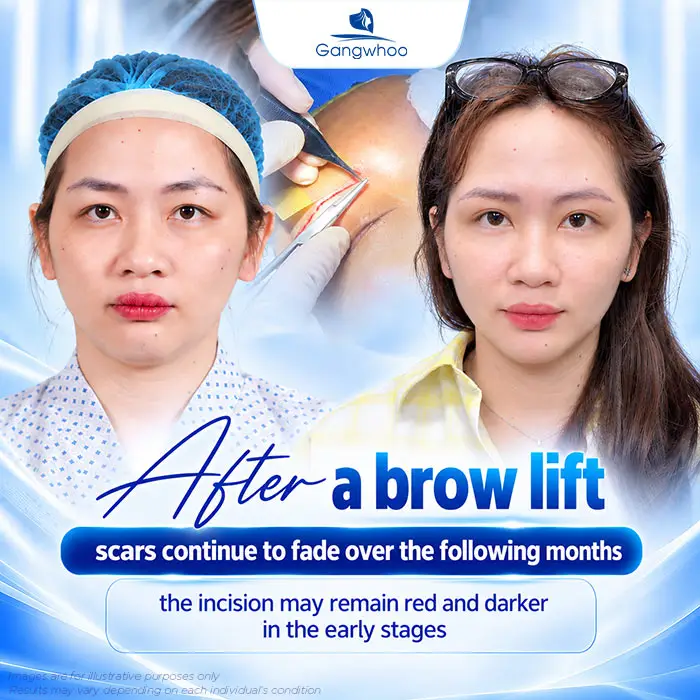 Does Brow Lift Surgery Leave Scars? A Guide to Minimizing Scarring