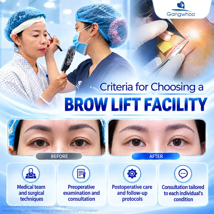 Does Brow Lift Surgery Leave Scars? A Guide to Minimizing Scarring