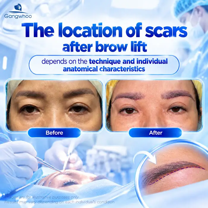 Does Brow Lift Surgery Leave Scars? A Guide to Minimizing Scarring