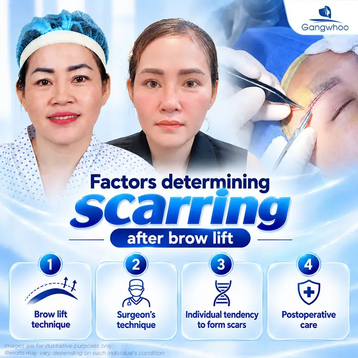 Does Brow Lift Surgery Leave Scars? A Guide to Minimizing Scarring