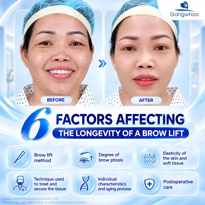 How Long Does an Eyebrow Lift Last? Aftercare Guide