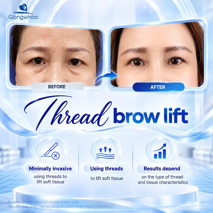 How Long Does an Eyebrow Lift Last? Aftercare Guide