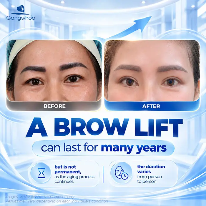 How Long Does an Eyebrow Lift Last? Aftercare Guide