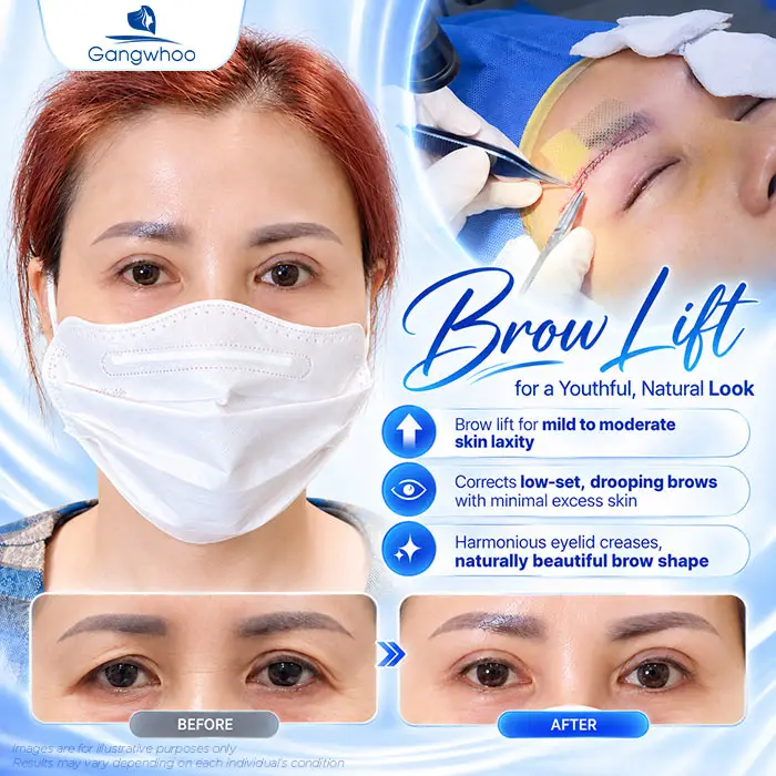 How Long Does an Eyebrow Lift Last? Aftercare Guide