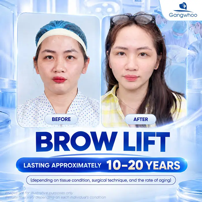 How Long Does an Eyebrow Lift Last? Aftercare Guide