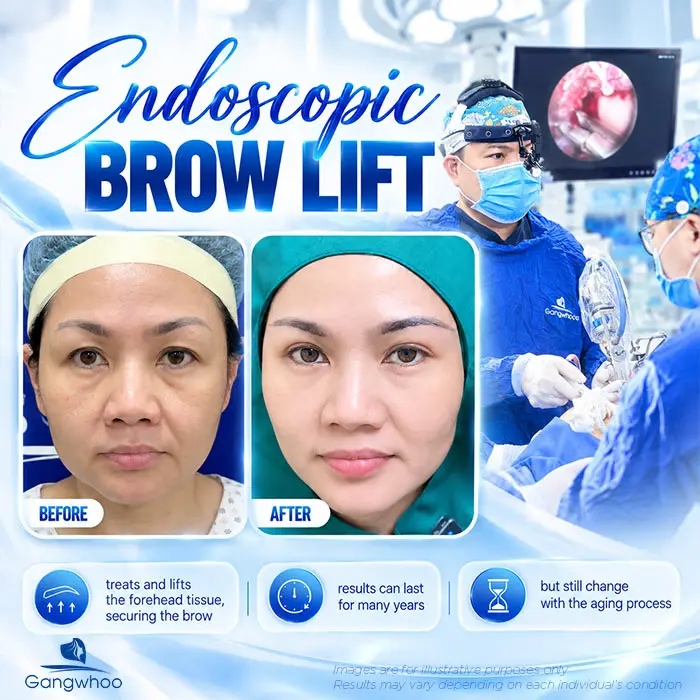 How Long Does an Eyebrow Lift Last? Aftercare Guide