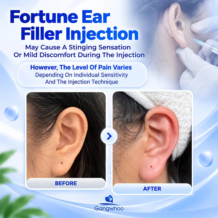 Does Fortune Earlobe Filler Injection Hurt? Pain Level And Ways To Reduce Discomfort