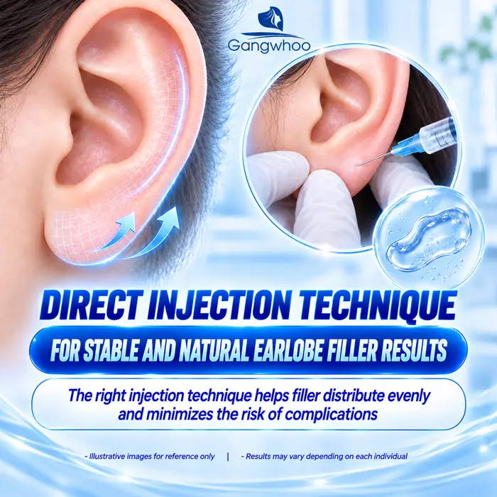 How Long Does Lucky Ear (Earlobe) Filler Injection Last? Factors That Affect Whether You Need a Touch-Up