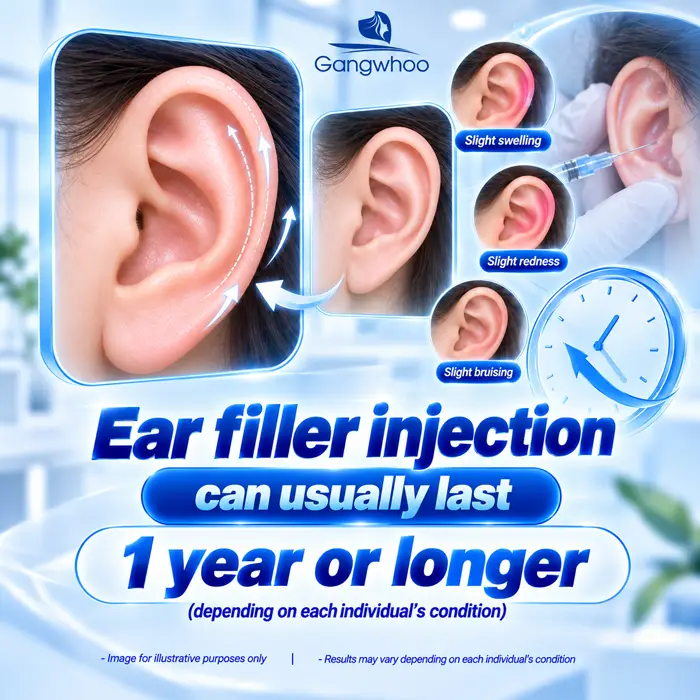 How Long Does Lucky Ear (Earlobe) Filler Injection Last? Factors That Affect Whether You Need a Touch-Up