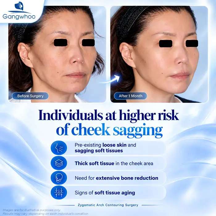 Does Cheekbone Reduction Cause Facial Sagging? Why Does Sagging Happen?